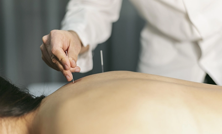 Acupuncture